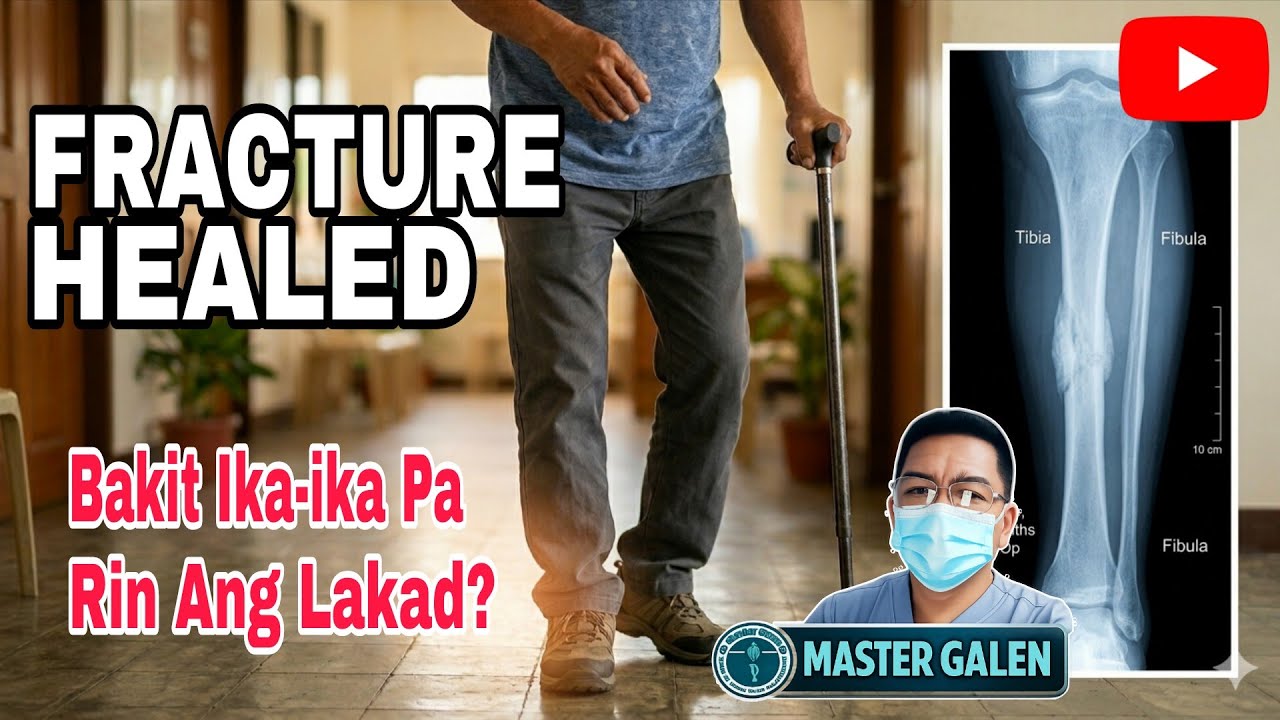 Magandang paglalakad  para sa magaling na nabaling buto