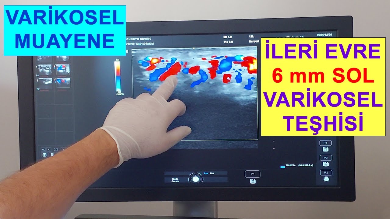 Varikosel Teşhisi: Sol Testiste 6 mm İleri Evre Varikosel