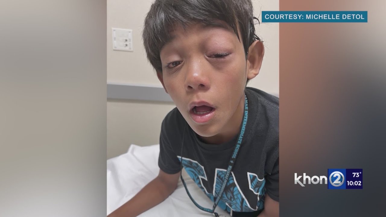 Boy left with severe eye injury after incident with hand sanitizer at Waianae Intermediate School
