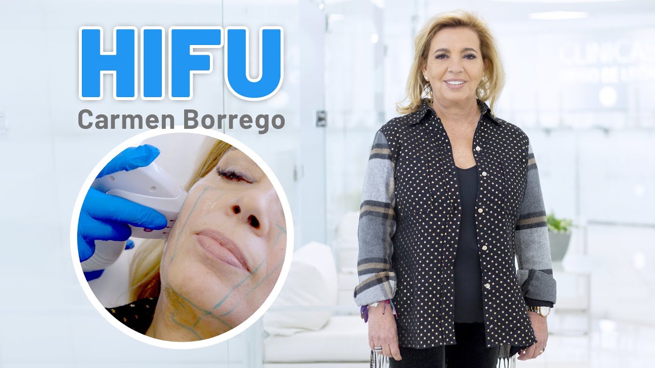 Carmen Borrego se realiza el tratamiento HIFU para combatir la flacidez del rostro