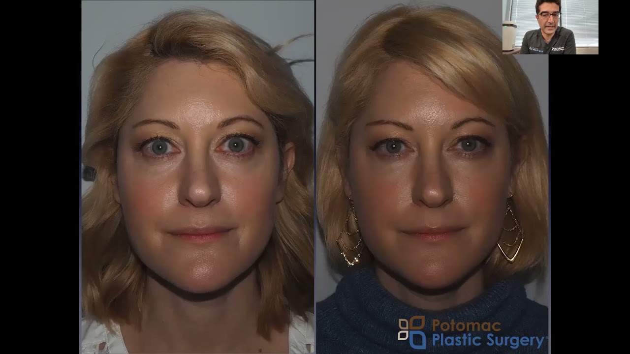 Potomac Plastic Surgery DC - Eyes, Eyelid, Brow