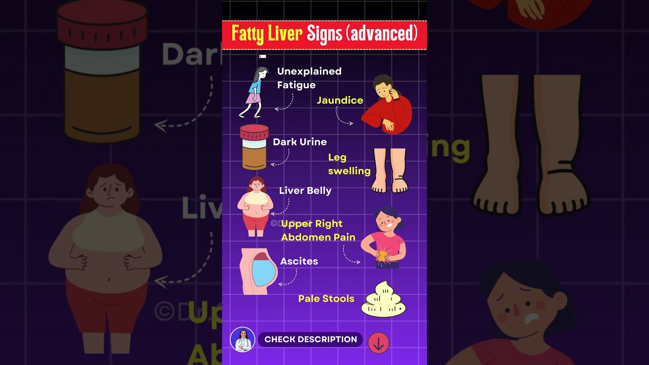 10 Warning Signs of Fatty Liver You Should Never Ignore! Fatty Liver Disease
