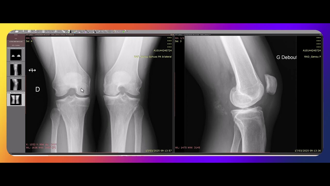 Radiographie de l'arthrose du genou : arthropathie f&eacute;morotibiale interne.