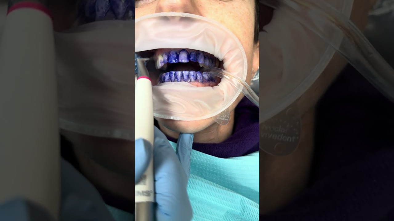 Dental Cleaning with AIRFLOW | New York General Dentistry