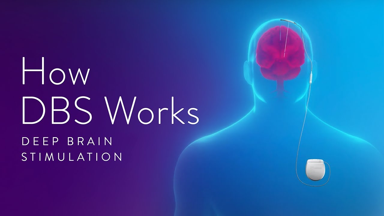 How Deep Brain Stimulation (DBS) Works
