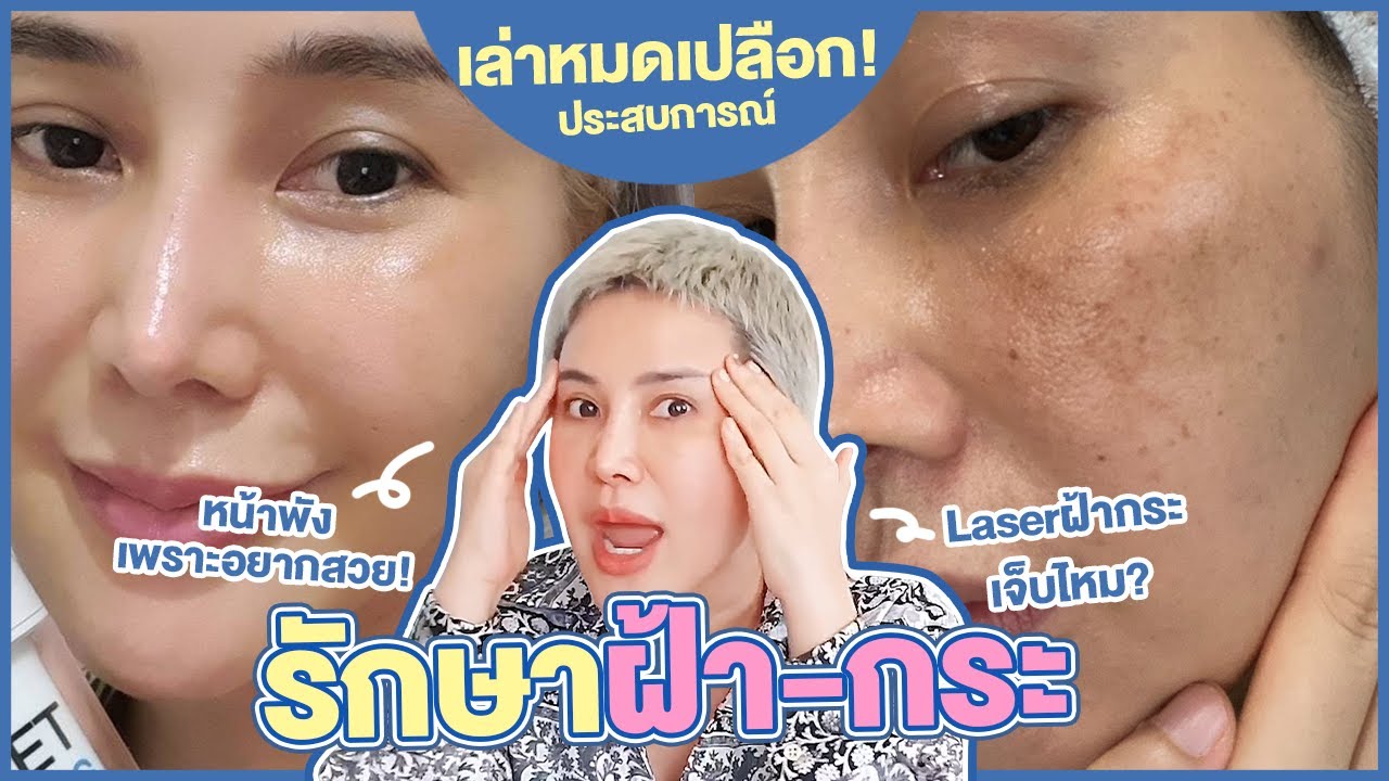 [CC ENG] ประสบการณ์ #รักษาฝ้ากระ แบบละเอียดยิบบบ !!  : I Aremakeup