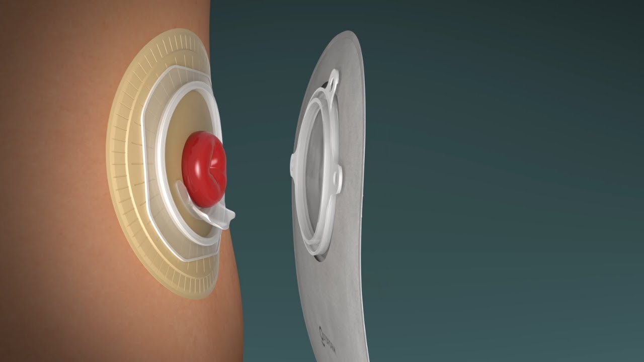 FLOWASSIST 2-Piece Pouch | Fitting Video