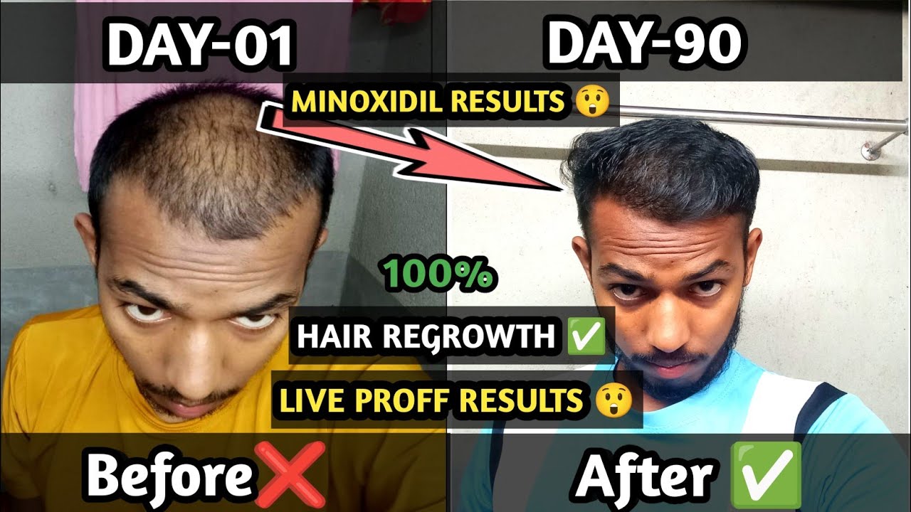 Minoxidil Hair Regrowth Journey Day-90/180| Before & After Journey