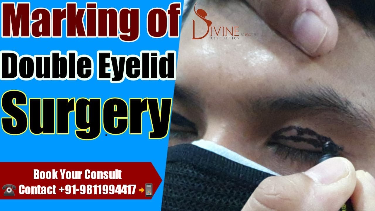 Marking of Double Eyelid Surgery