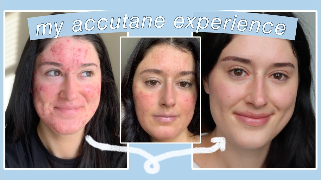 WHAT TO EXPECT WHILE TAKING ACCUTANE (isotretinoin)