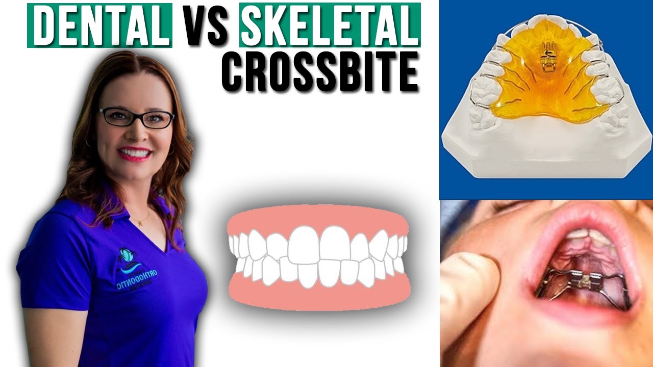 Dental vs Skeletal Expansion Crossbite in a Mixed-Dentition Patient- Should you Expand?