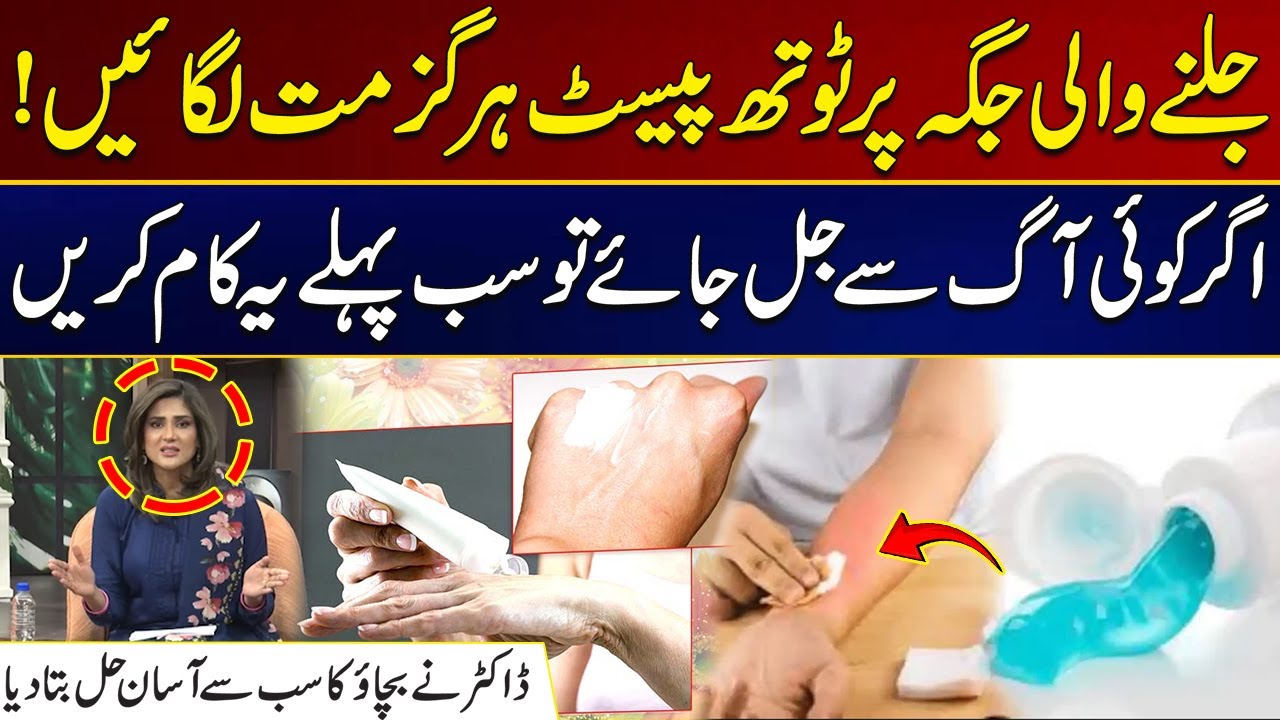 Burn Emergency | First Aid Steps Every Person Must Know | City 21
