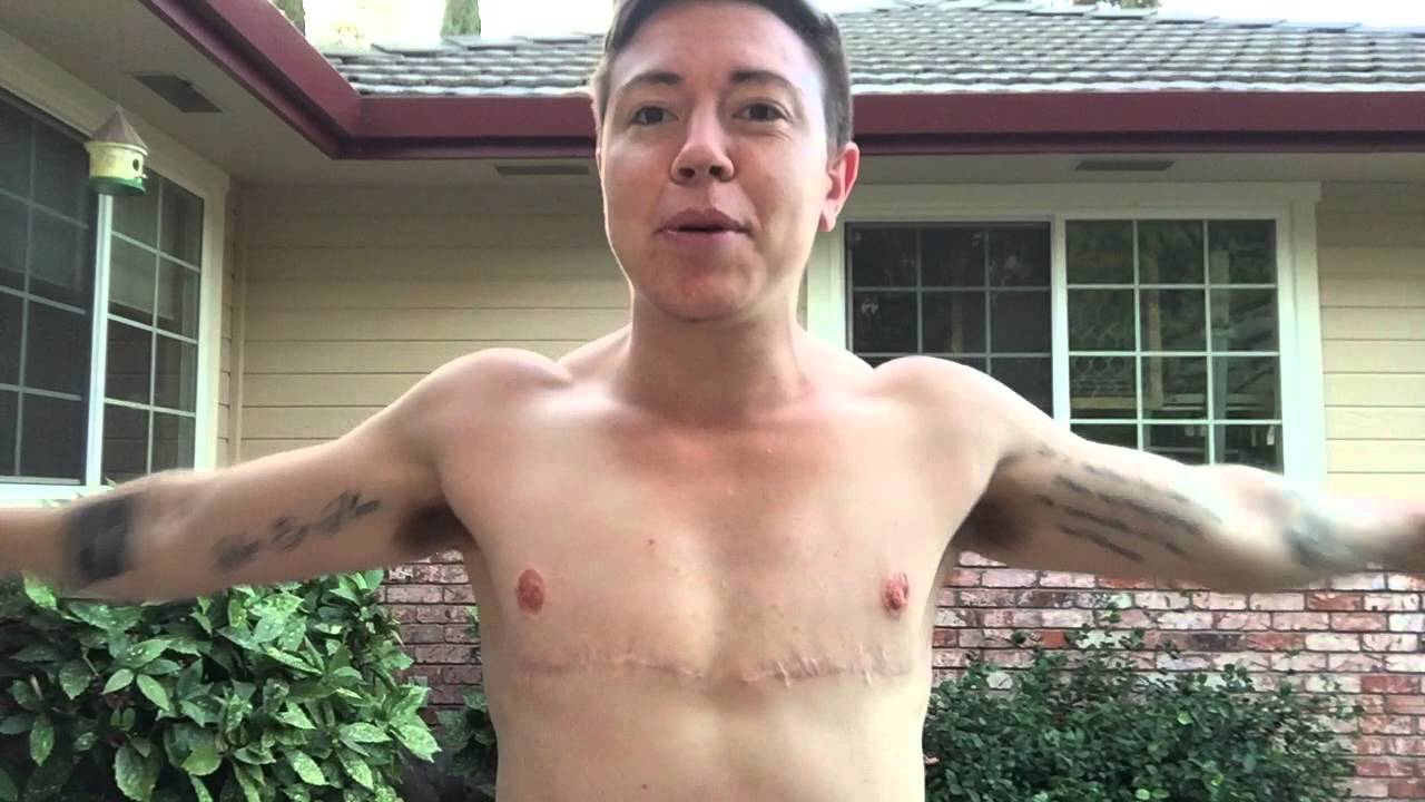 FTM: One Year Post-op Top Surgery