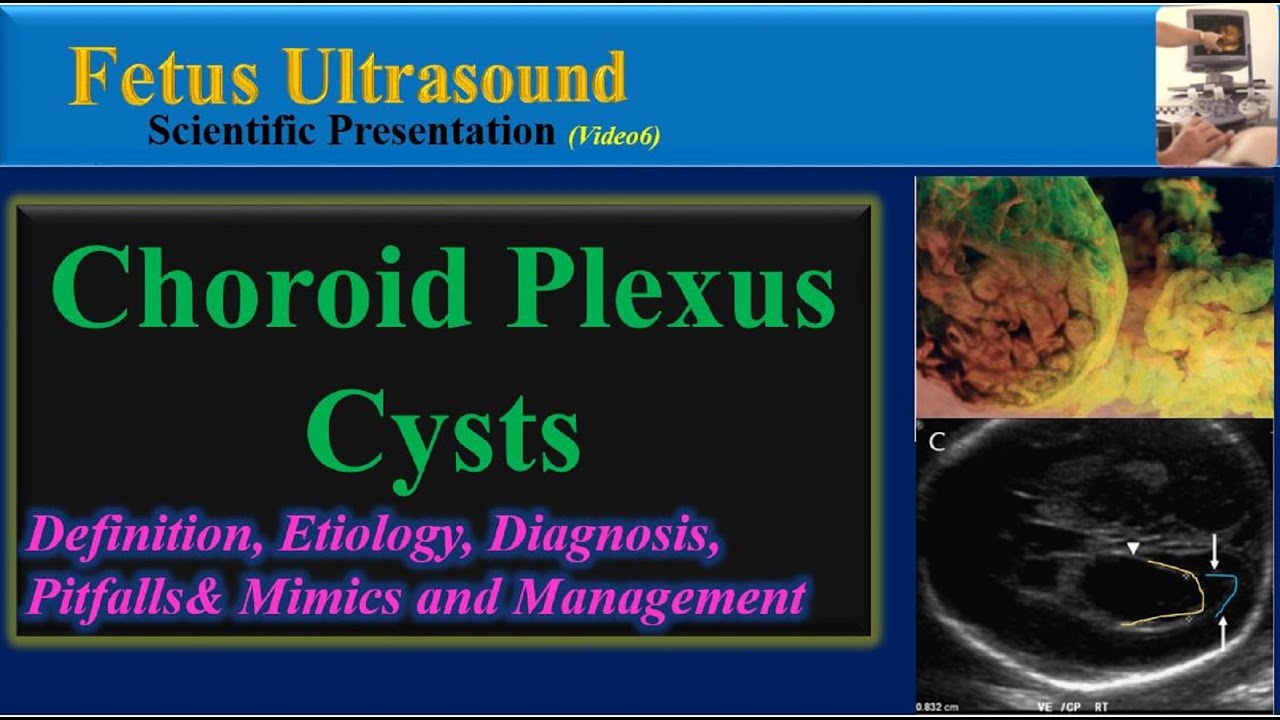 Fetus Ultrasound, Choroid Plexus Cyst