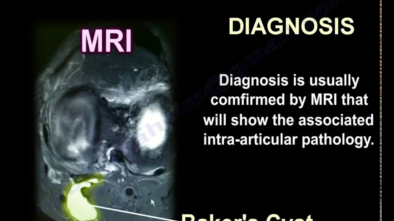 Baker's Cyst - Everything You Need To Know - Dr. Nabil Ebraheim