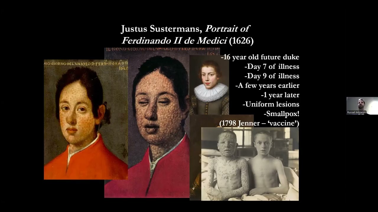 Did Caravaggio Catch Malaria?
