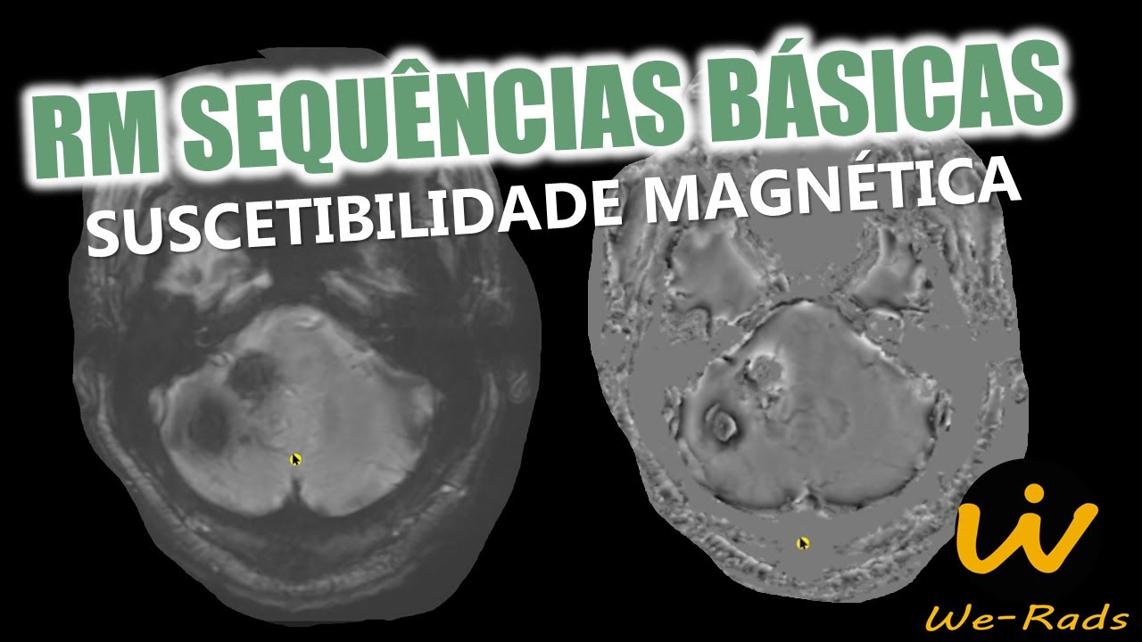 Suscetibilidade Magnética - Sequência Básica na Ressonância Magnética de Crânio