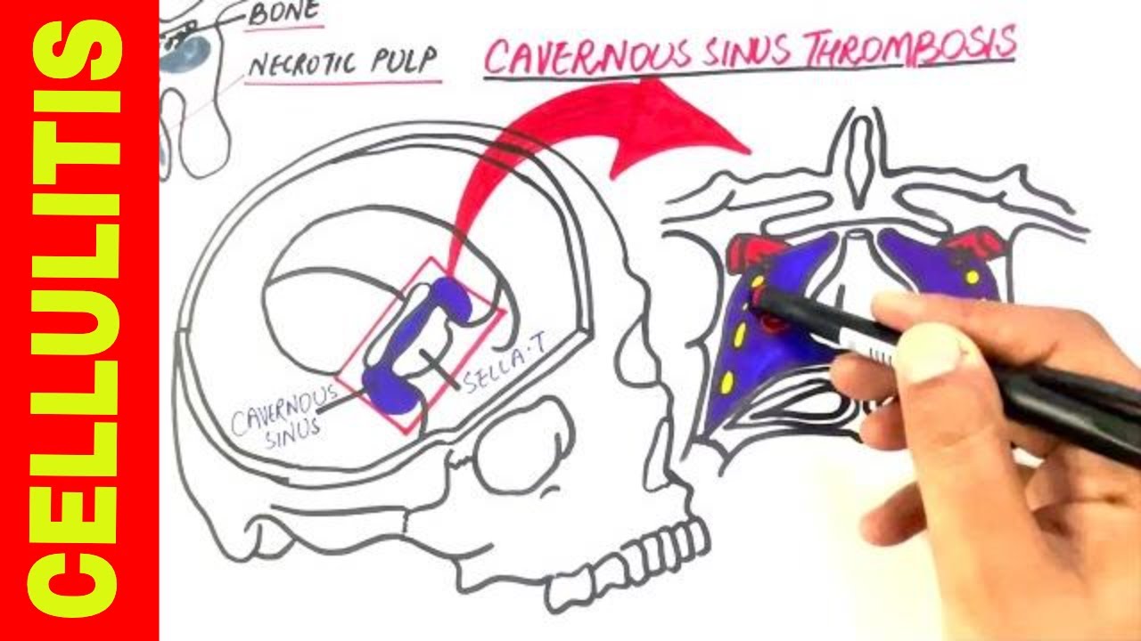 CELLULITIS | The Silent Killer!