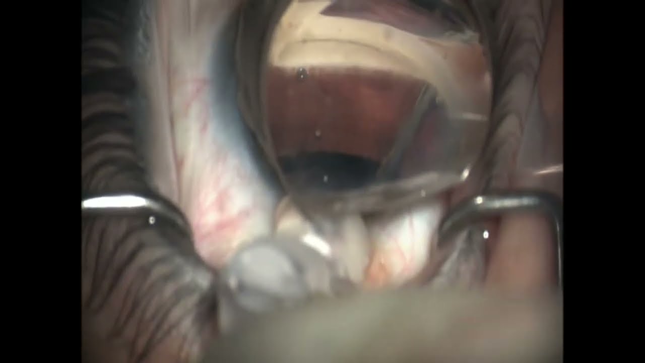 iStent Infinite for Glaucoma