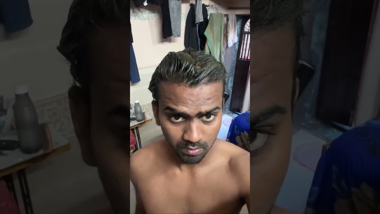HAIR COLOUR AFTER HAIR TRANSPLANT #sbl #hairtransplant #hairlosstreatment