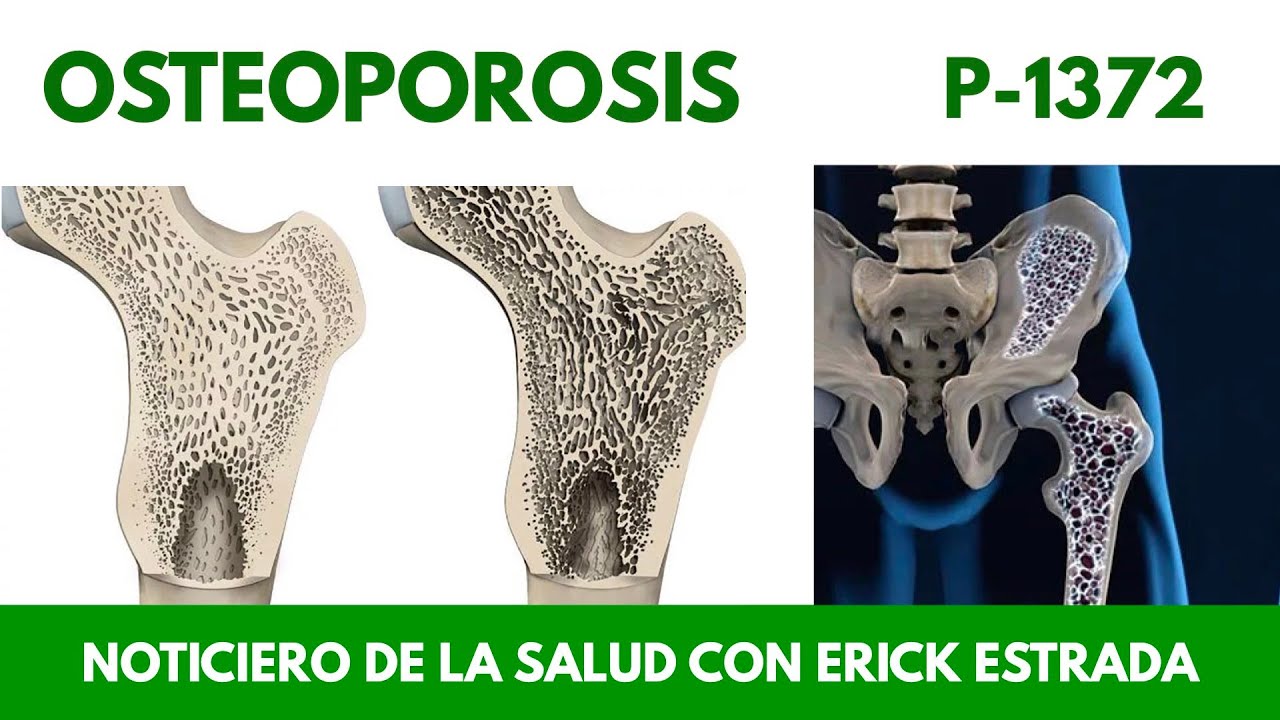 P-1372 Osteoporosis