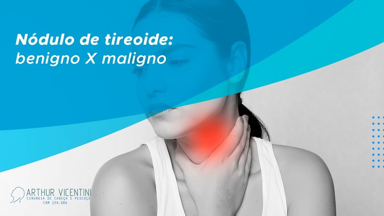N&oacute;dulo de tireoide: benigno X maligno | Dr. Arthur Vicentini CRM 154.086