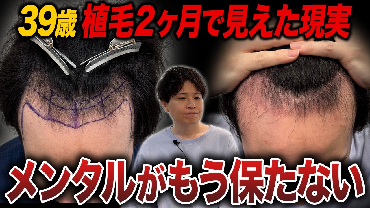 【薄毛治療】植毛手術をして2ヶ月経過した30代メンズの現在の頭皮状態は!?