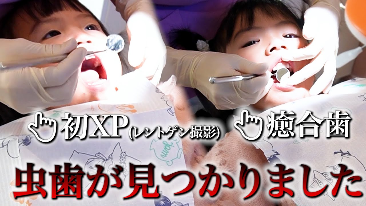 【虫歯発覚!?】癒合歯・前歯の神経も無い久々の歯のメンテナンスでまさかの虫歯も見つかり冷や汗😭次女は初めてのレントゲンができるのか不安...パパに歯の欠損ありなので次女の歯も心配でした...😭