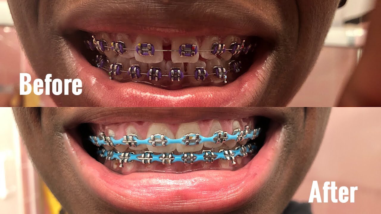 FULL BRACES JOURNEY: 1 & 1/2 YEARS (GAPS, SMALL OVERBITE, CHAINS AND OVERALL EXPERIENCE)
