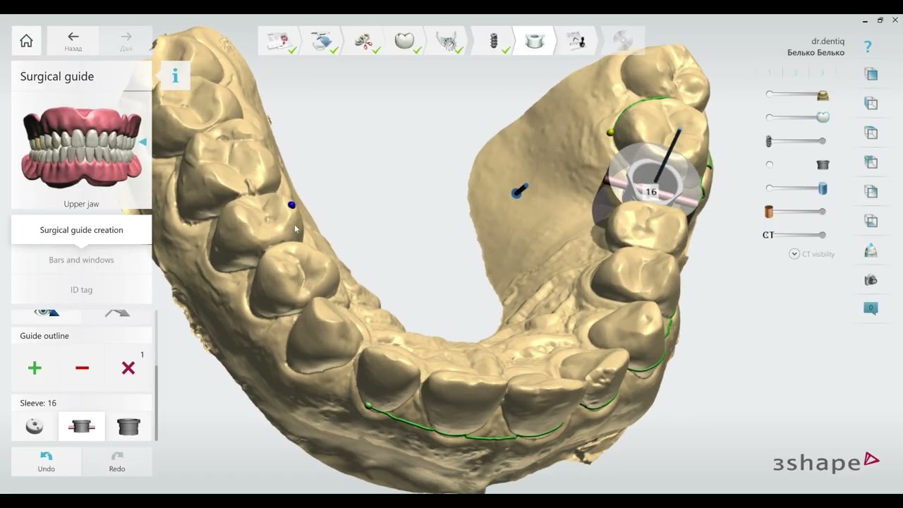 3Shape Implant Studio