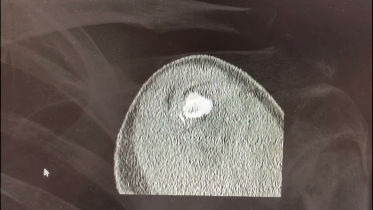 Pseudoartrosis humero proximal