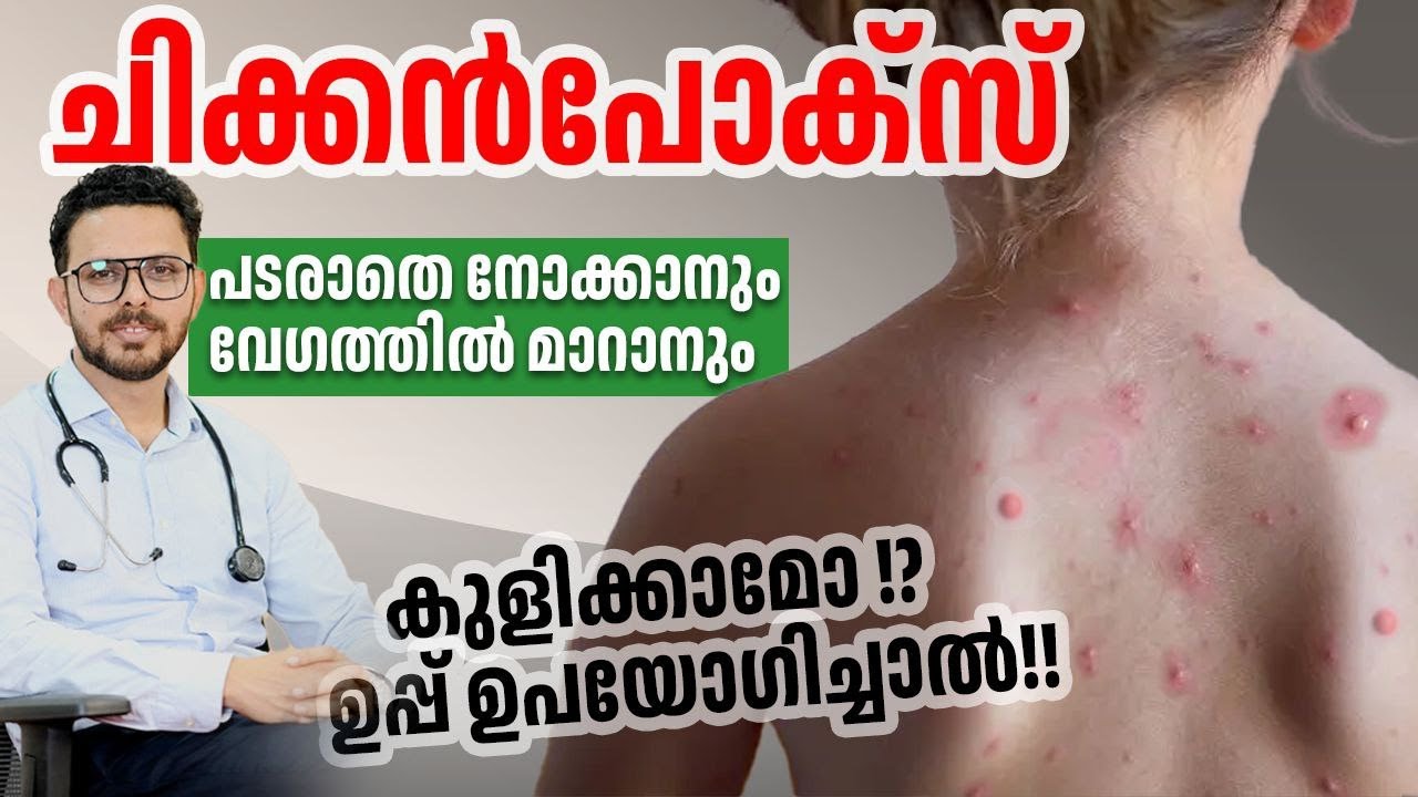 ചിക്കൻപോസ് വേഗം മാറിപോകാൻ | chickenpox malayalam | Dr. Fasil Mohammed