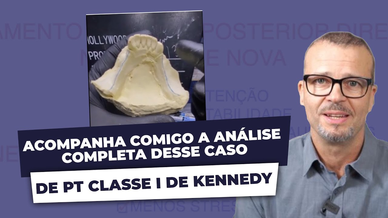 Prótese Classe I de Kennedy: o que você precisa saber!