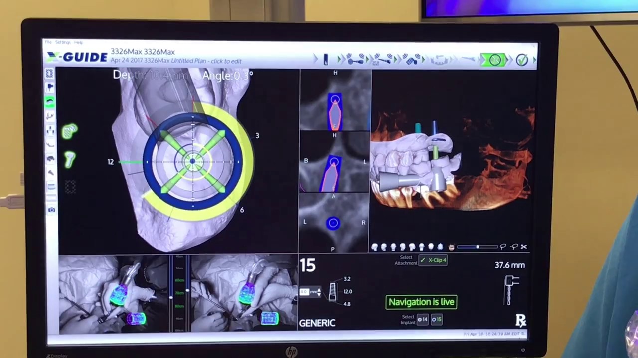 X-Guide Navigated Osteotome