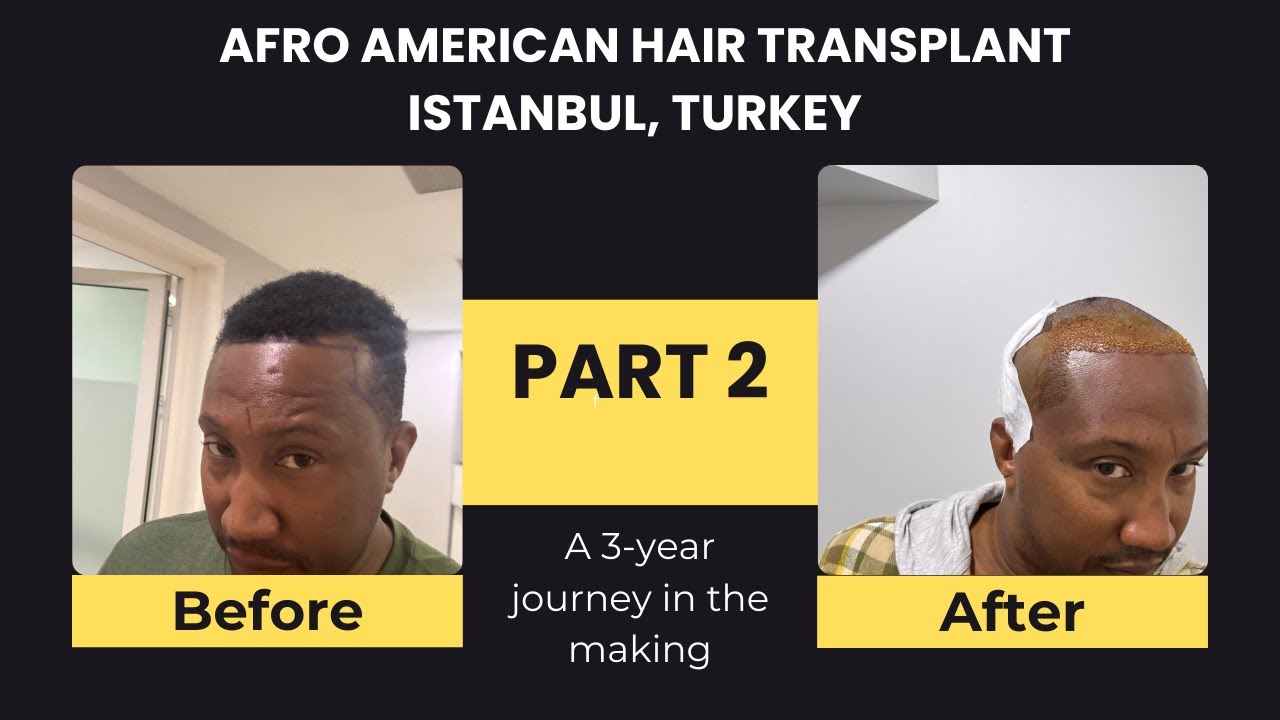 Part 2: Operation Day-Hair Transplant in Istanbul, Turkey