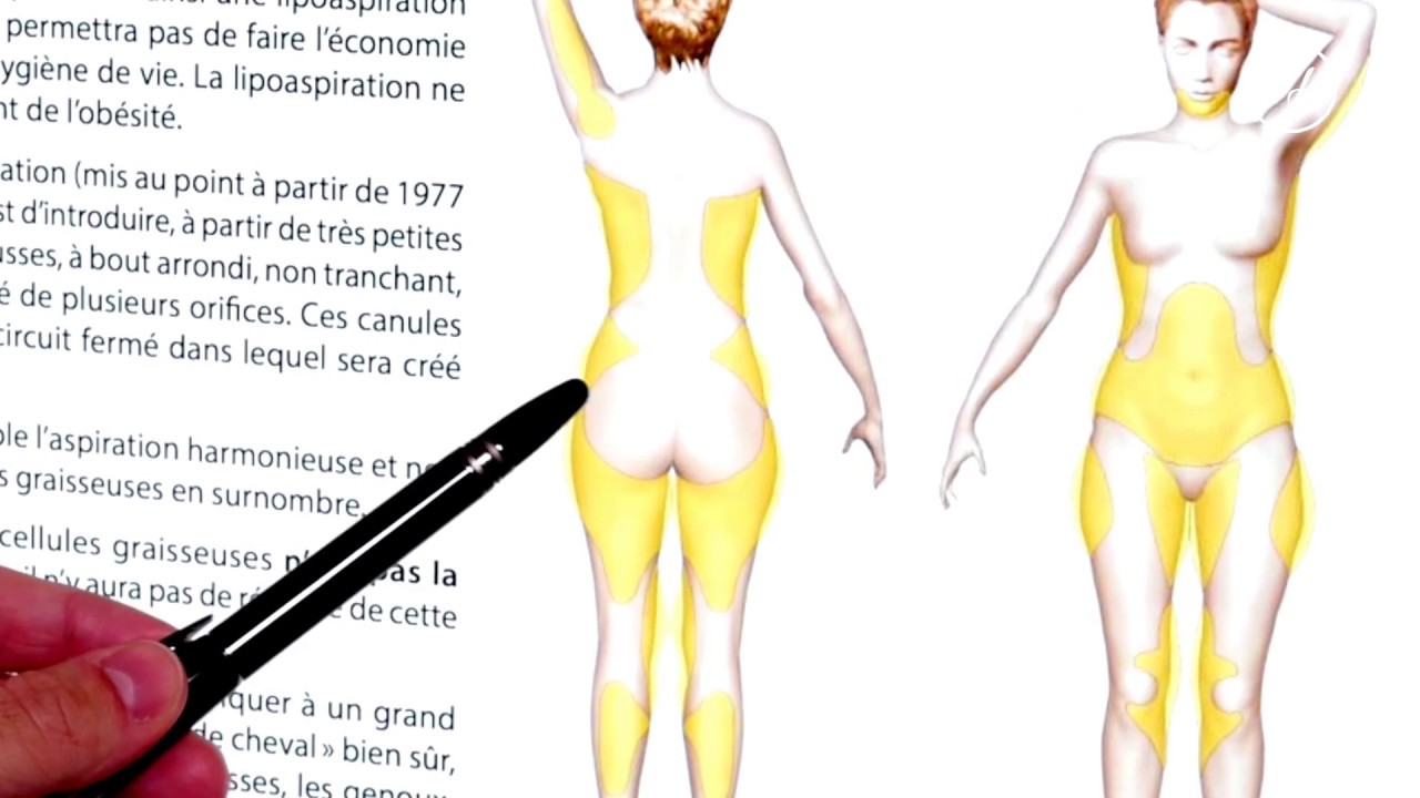 Liposuccion a Paris : explications du chirurgien esthétique