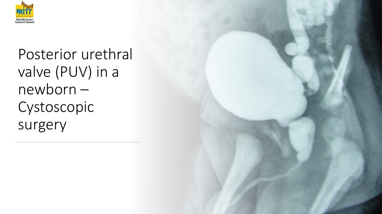 Posterior urethral valves (PUV) in a newborn- Cystoscopic  surgery- by Dr A.K.Singal, Mumbai