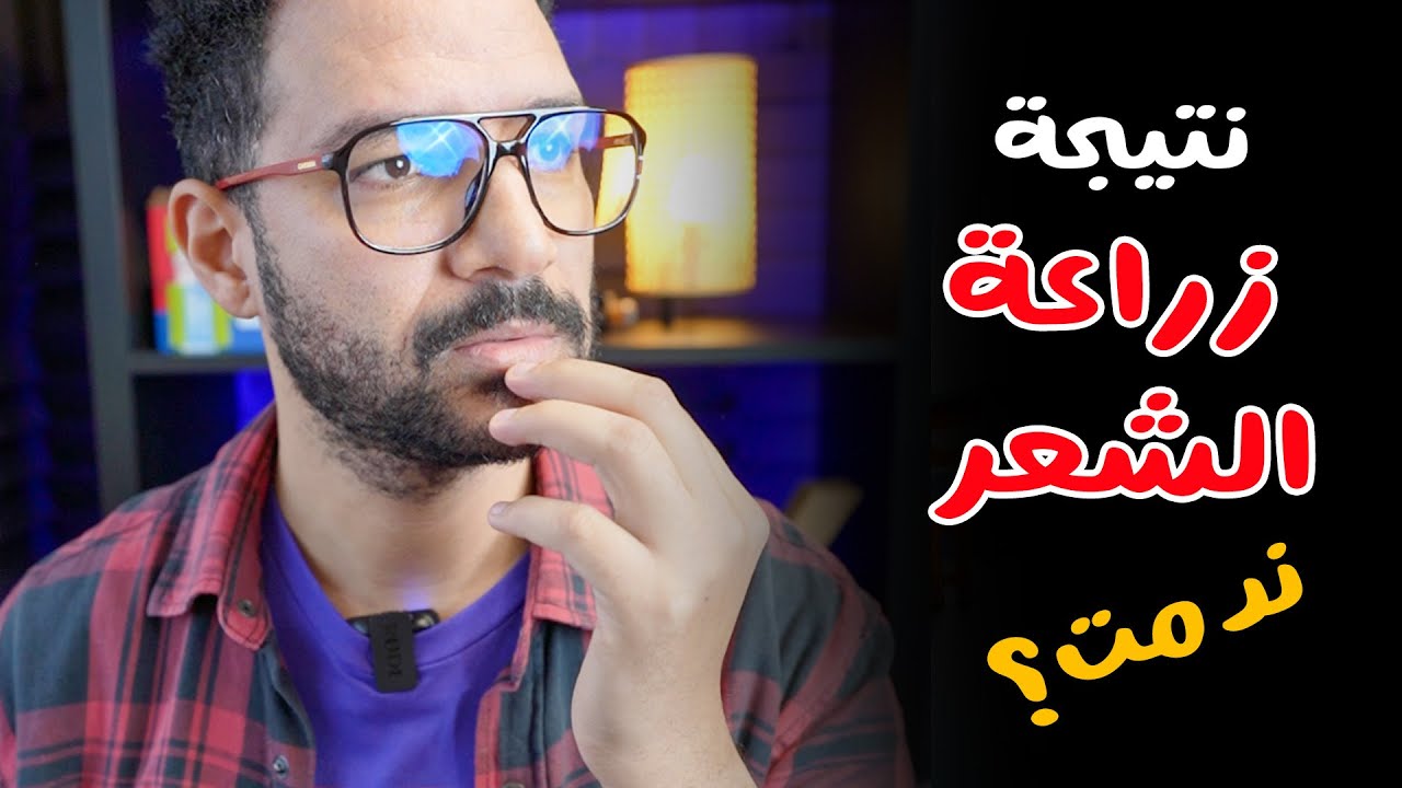 نتيجة زراعة شعري بعد 6 شهور