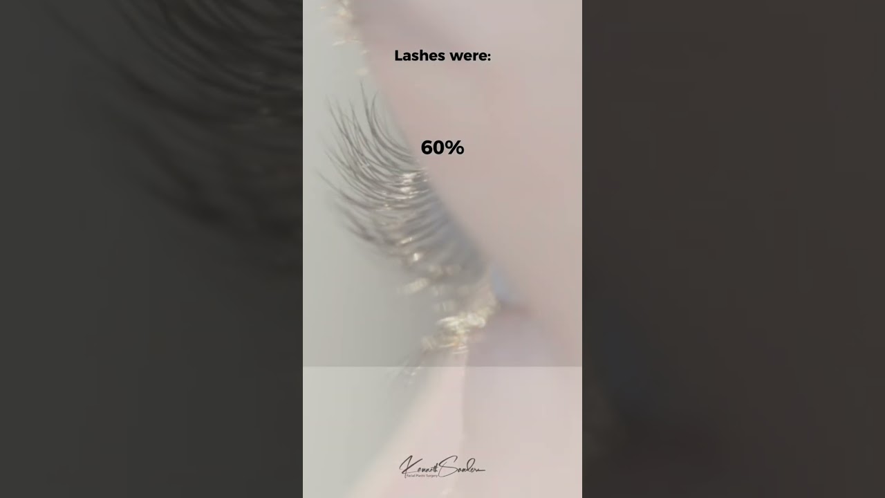 Long Eyelashes created by Latisse