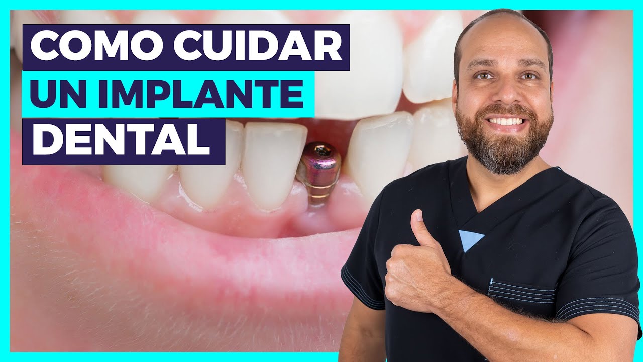 ¿Cómo CUIDAR mis IMPLANTES Dentales? 🤔 [Todas tus PREGUNTAS Respondidas] ⚡