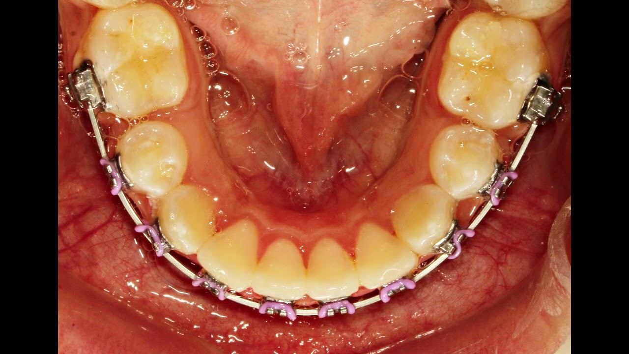 Goodbye Crowded Teeth! My Amazing Orthodontic Results.