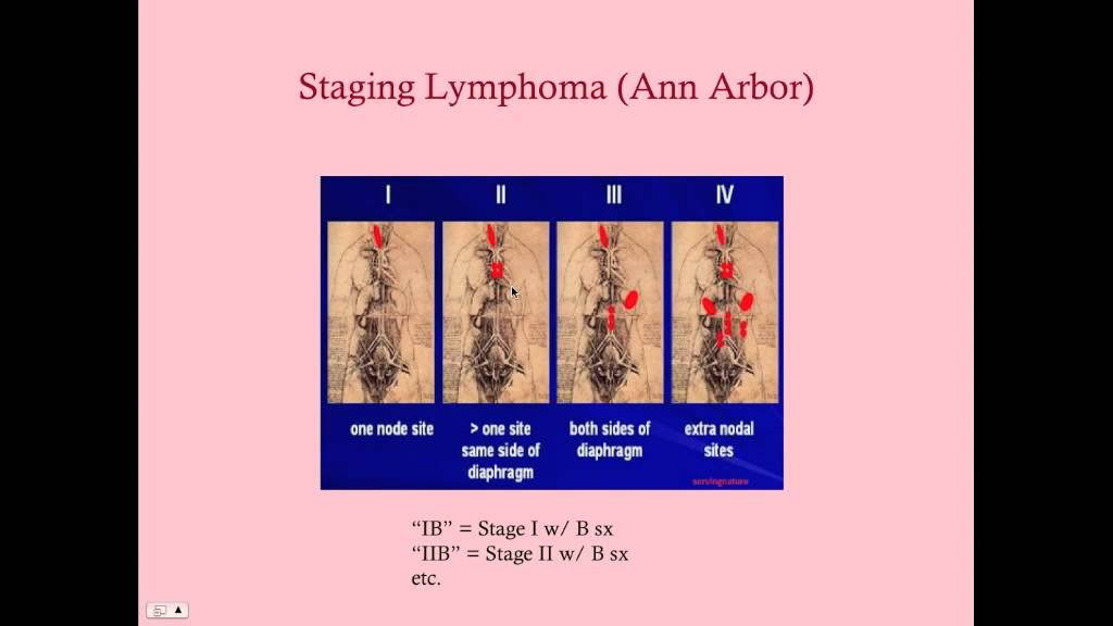 Hodgkin's Disease - CRASH! Medical Review Series