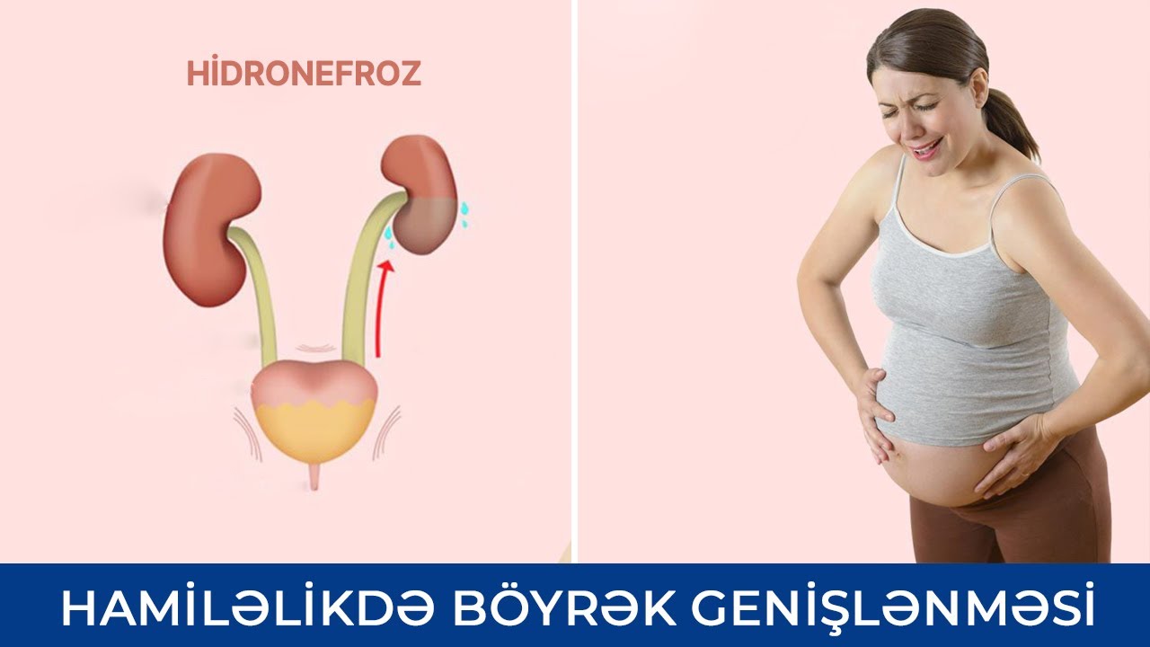 Hidronefroz - Hamiləlikdə böyrək genişlənməsi -  Elza Binnətova ( Uroloq)