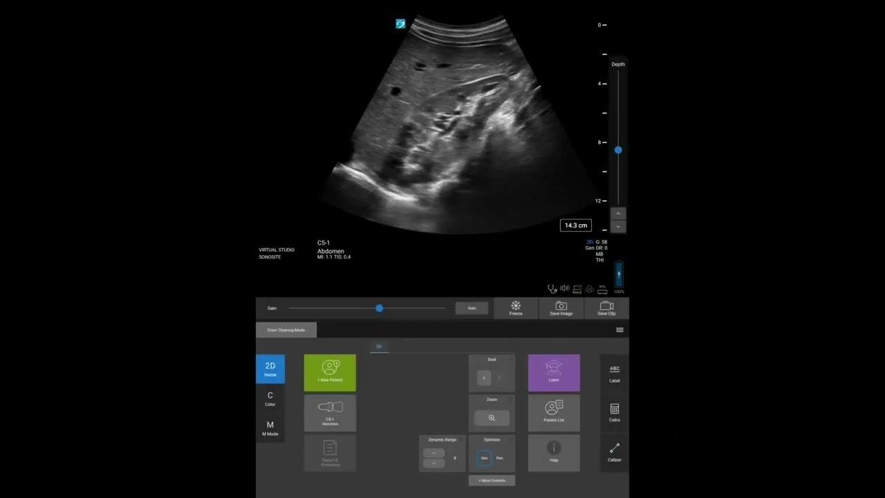 Sonosite ST: Taking Measurements