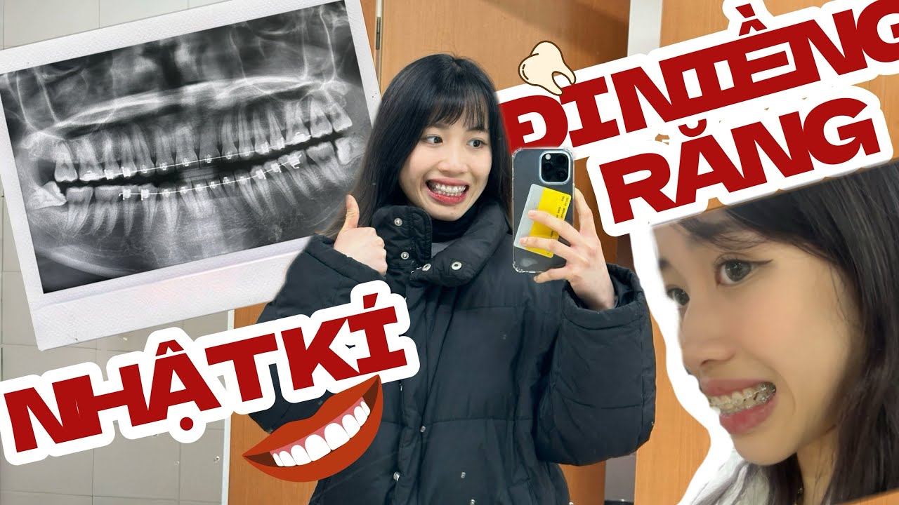 CHIN DAILY|| Nhật kí đi niềng răng 🦷