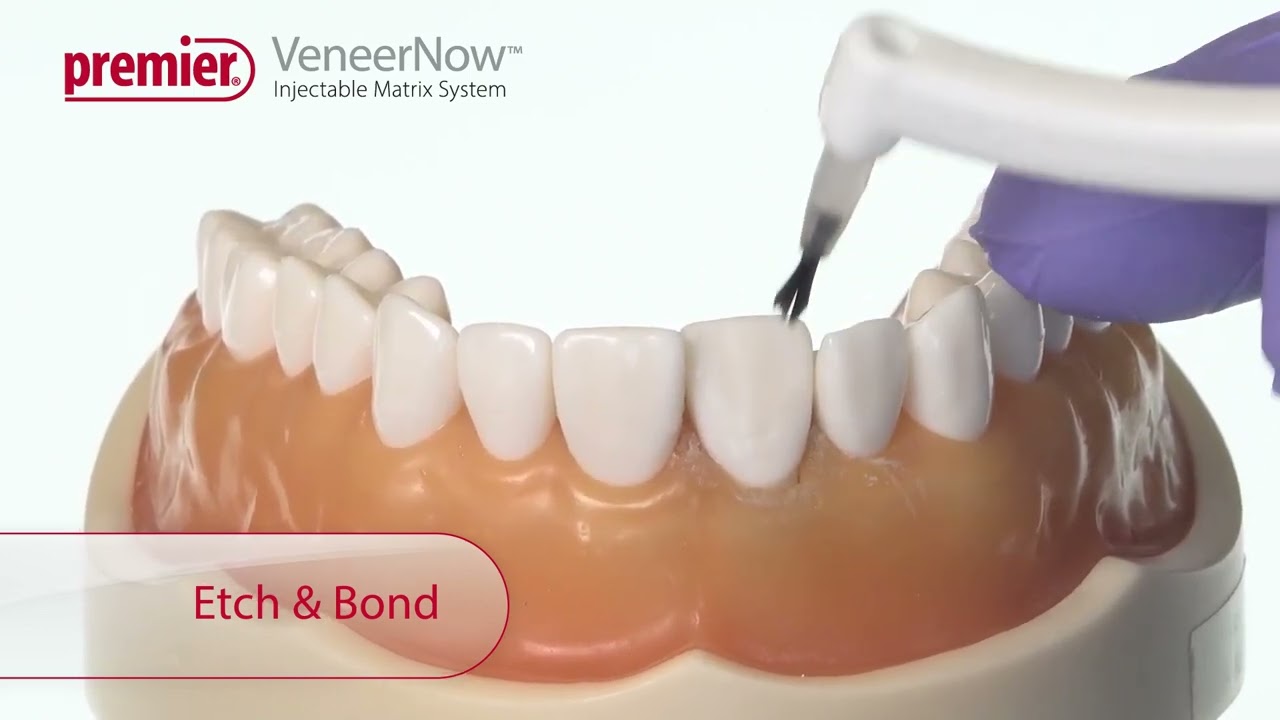 VeneerNow™ Injectable Matrix System - For Misaligned Teeth