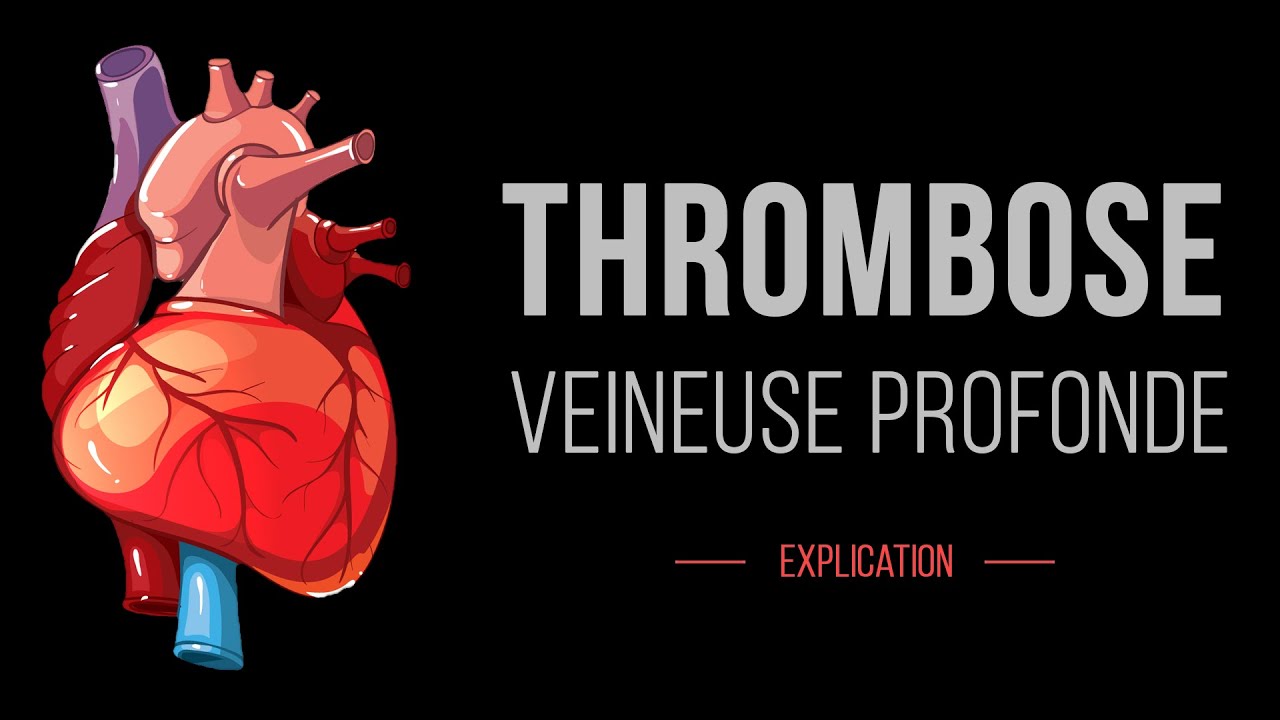 Thrombose Veineuse Profonde :  Cardiologie - Détails