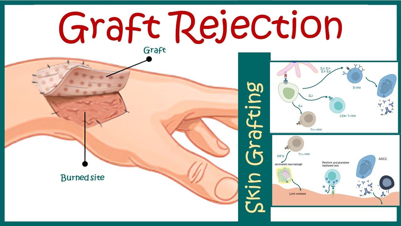 Graft rejection || Immunological basis of graft rejection