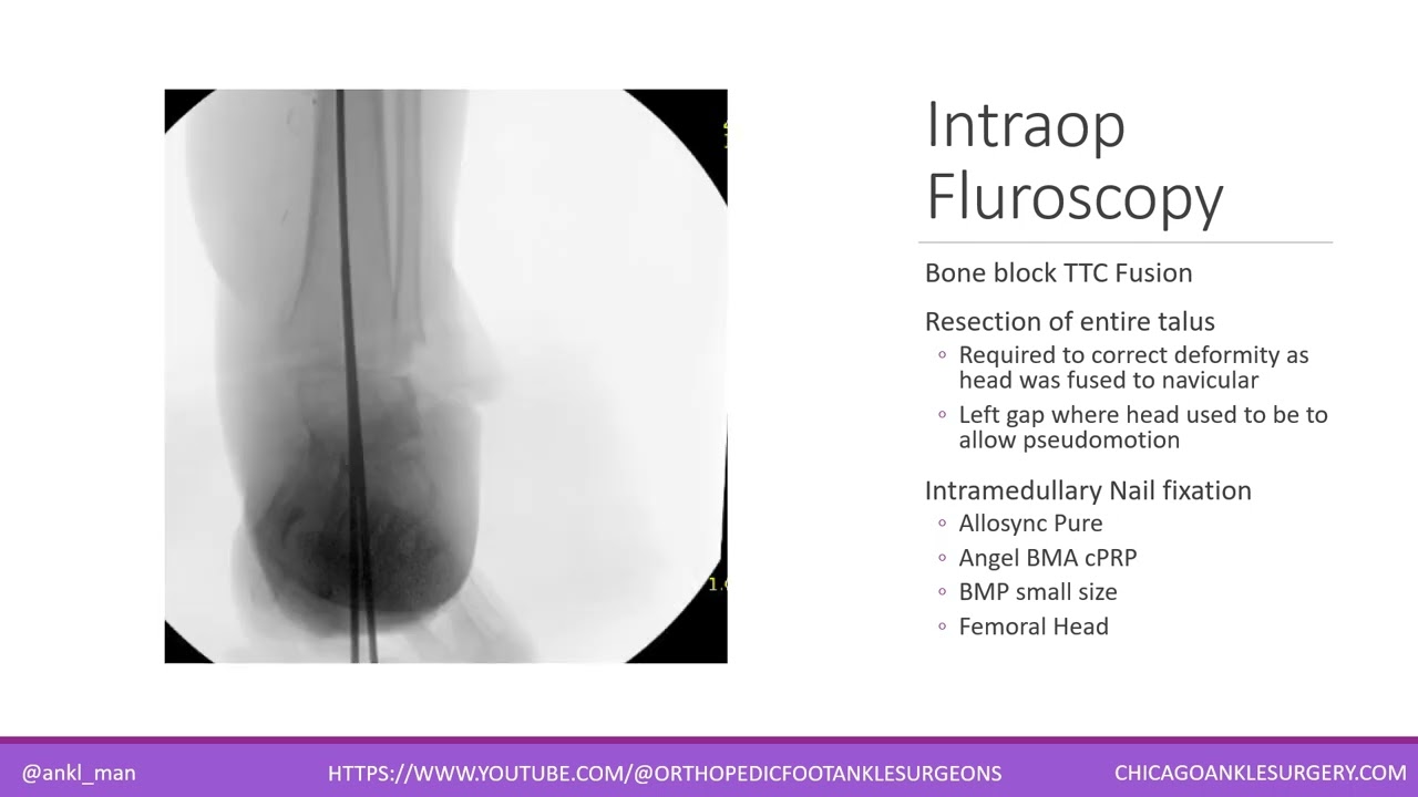 Rigid Cavovarus Deformity - Tibiotalocalcaneal (TTC) Fusion Intramedullary Nail - Case Presentation
