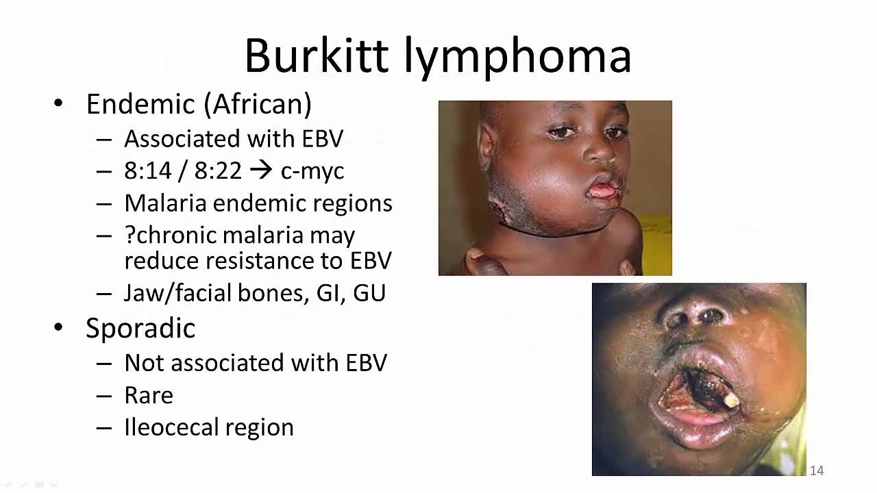 3. Chronic EBV